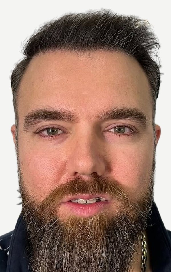 After hair transplant, Daniel