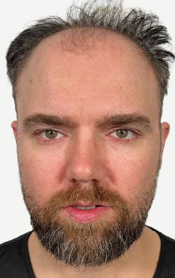 Before hair transplant, Daniel