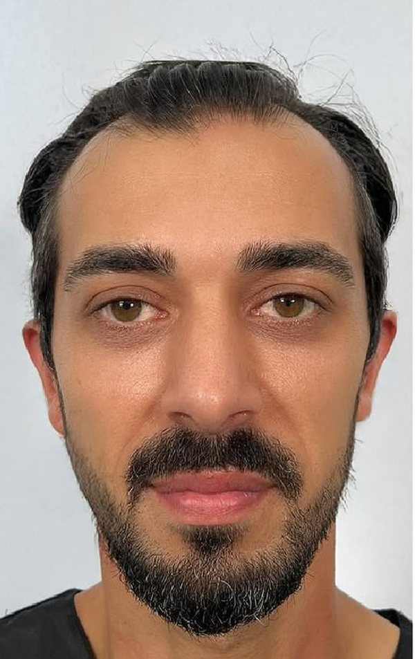 Before hair transplant, James