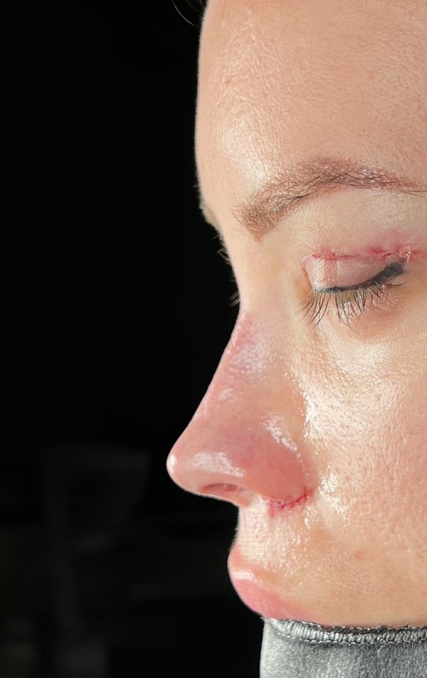 After rhinoplasty, Patient F