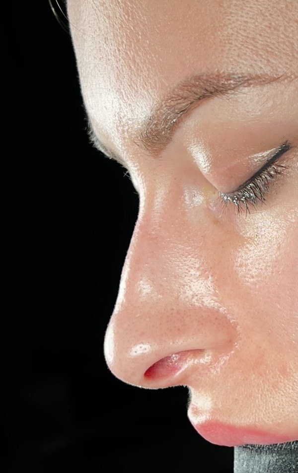 Before rhinoplasty, Patient F