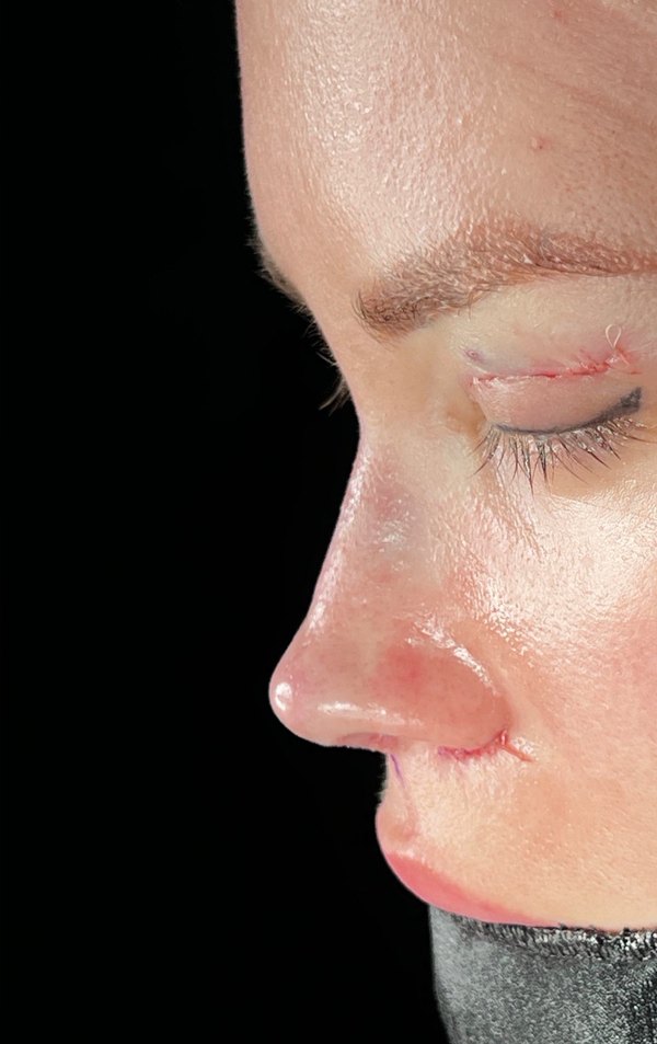 After rhinoplasty, Patient A