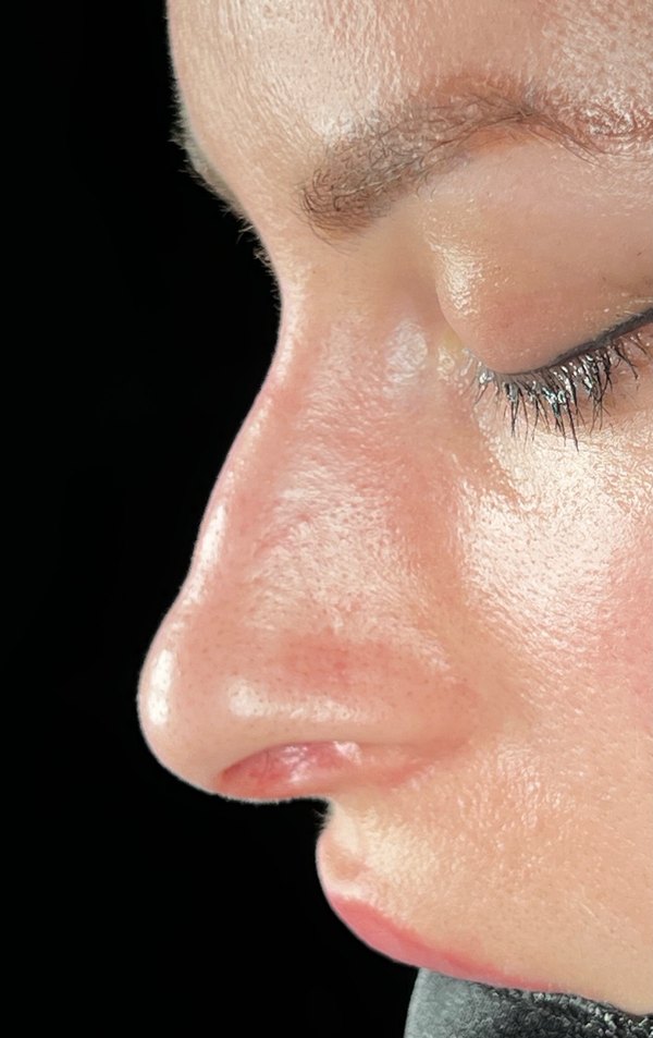 Before rhinoplasty, Patient A