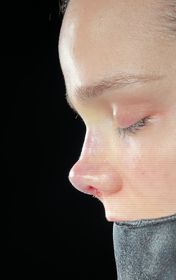After rhinoplasty, Patient B