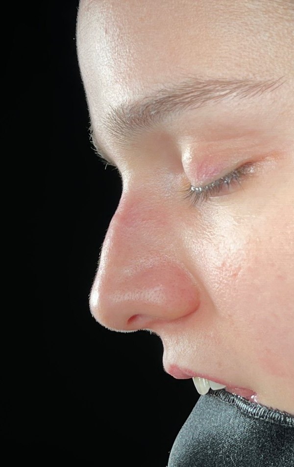 Before rhinoplasty, Patient B