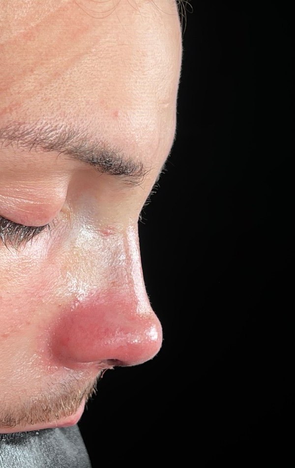 After rhinoplasty, Patient G