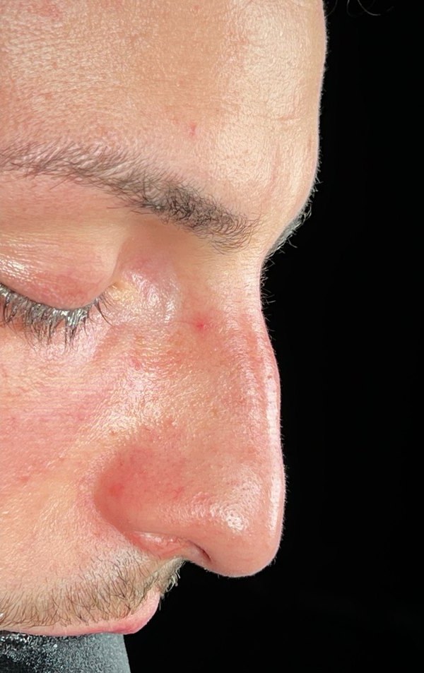 Before rhinoplasty, Patient G
