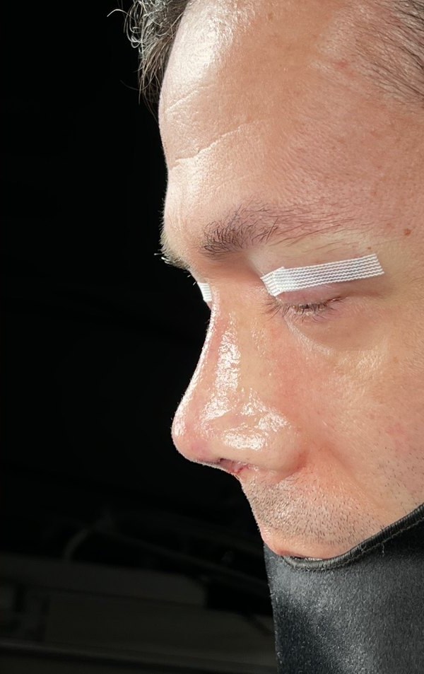 After rhinoplasty, Patient H