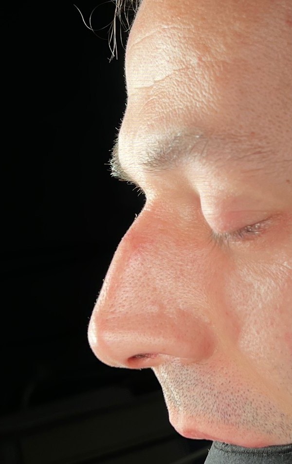 Before rhinoplasty, Patient H