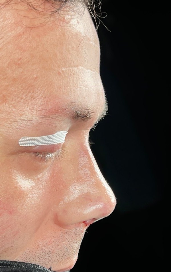 After rhinoplasty, Patient I