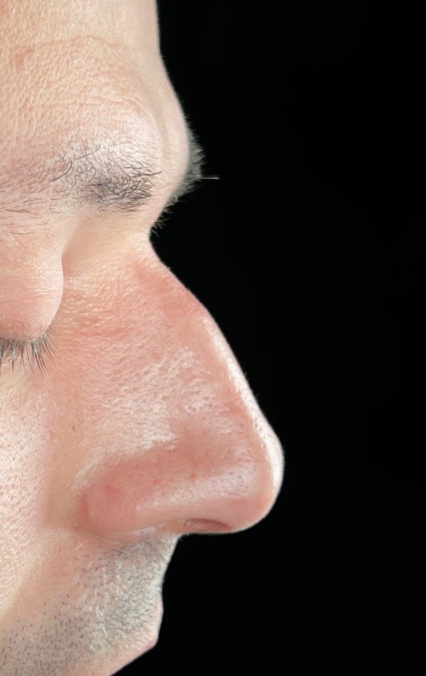 Before rhinoplasty, Patient I