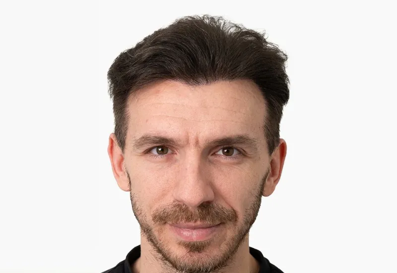 Ігор — результат трансплантації волосся